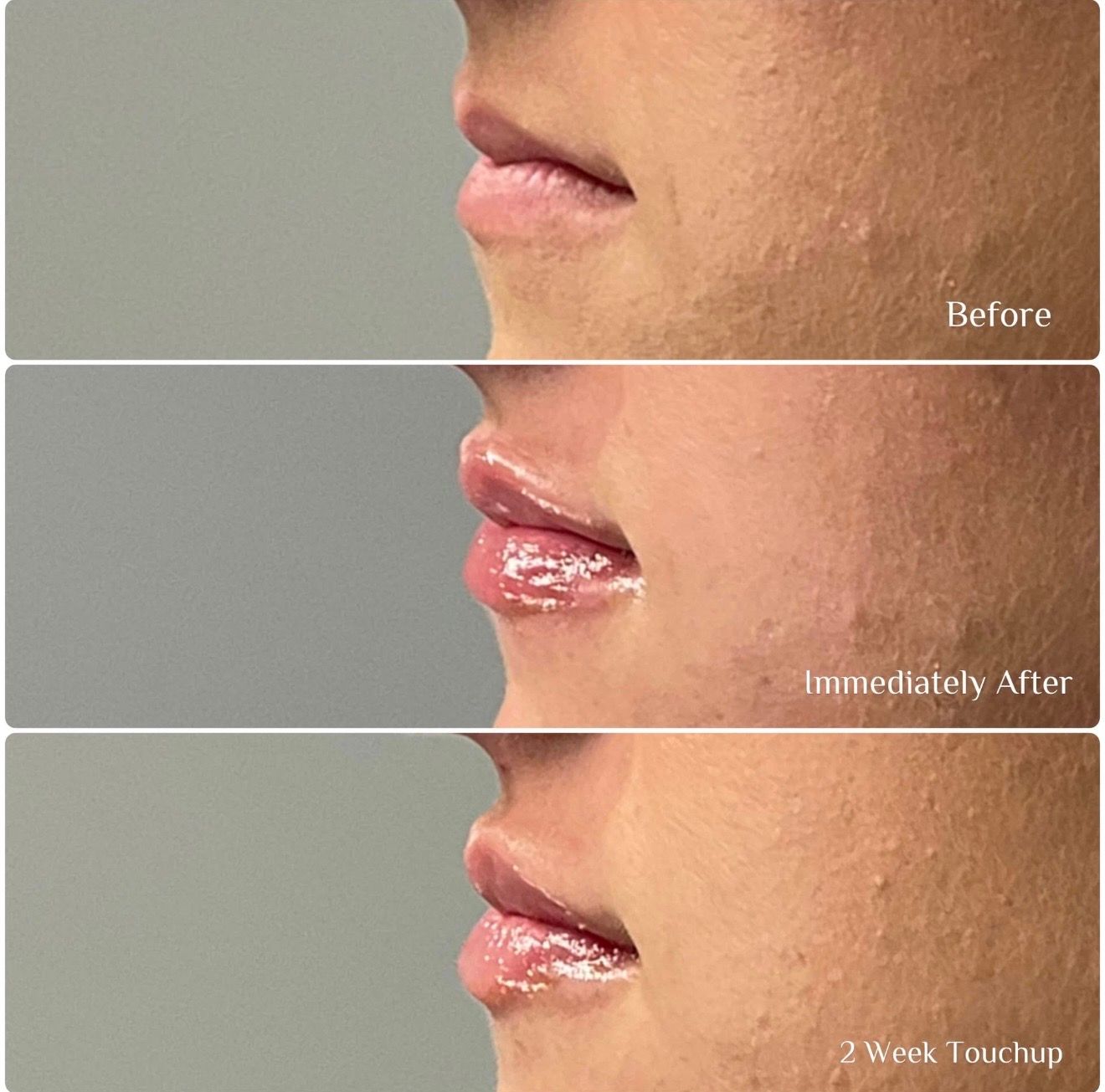 Three side-by-side lip close-ups showing before, immediately after, and one week after treatment
