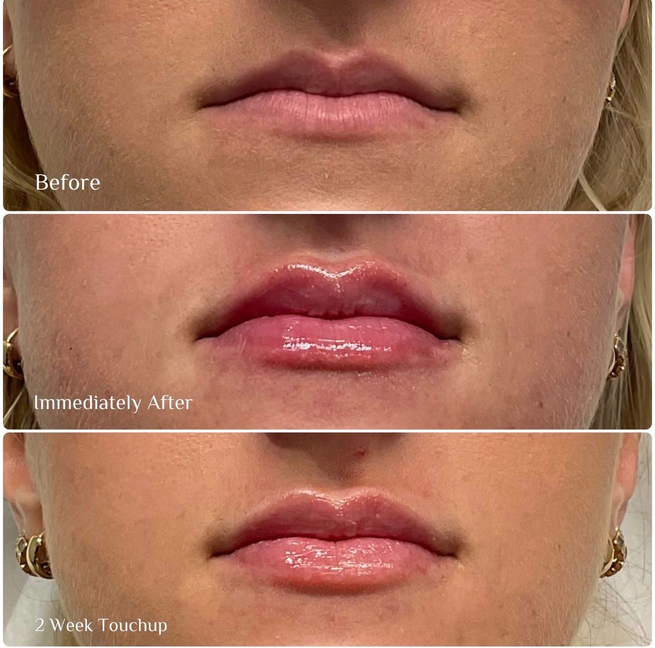 Before, immediately after, and 2-week touchup photos of glossy lip enhancement results.
