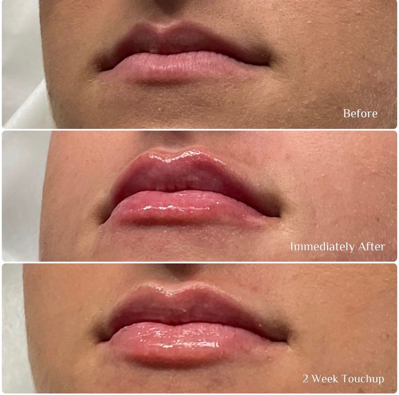 Three-panel close-up of lips before, immediately after, and two weeks after lip treatment
