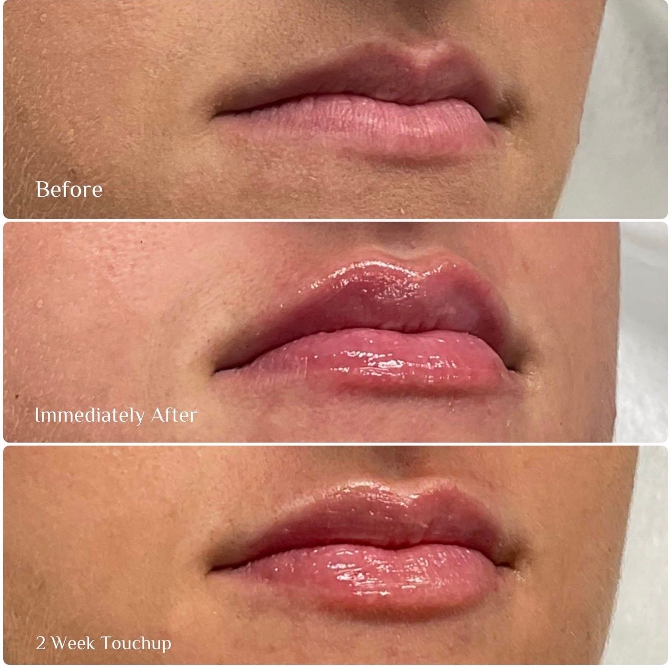 Three lip images showing before, immediately after, and two-week touchup gloss enhancement