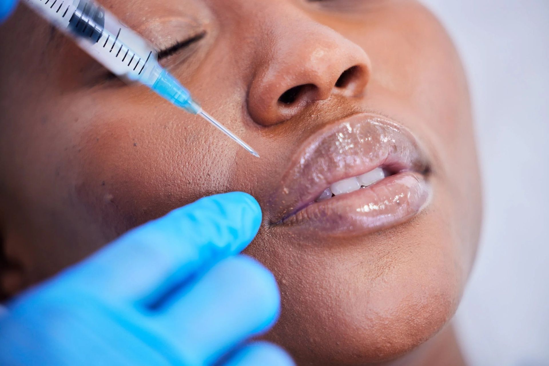 Gloved hand injecting filler into a person’s lips with a syringe