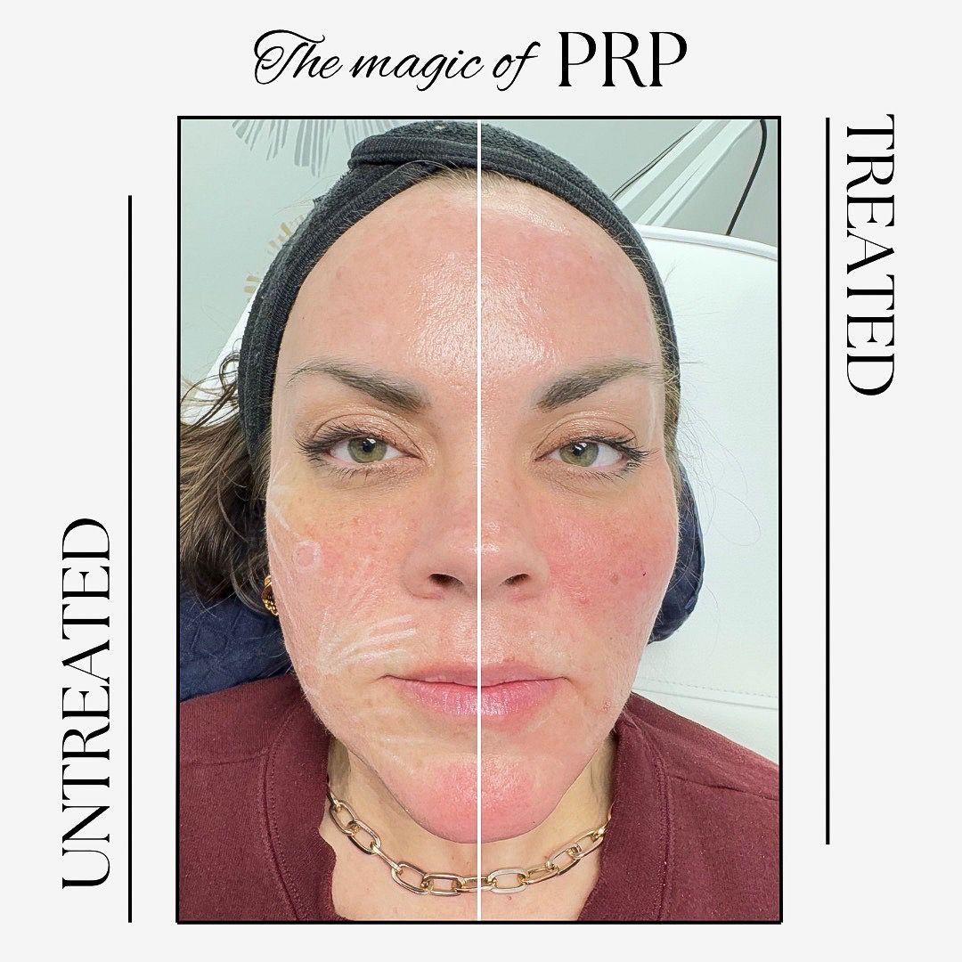 A woman's face before and after a PRP treatment
