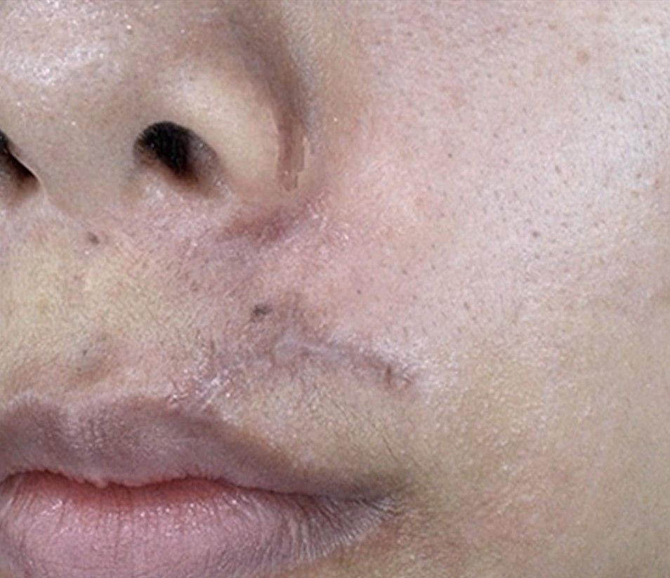 Close-up of a face with dark patches and irritation around the mouth and upper lip