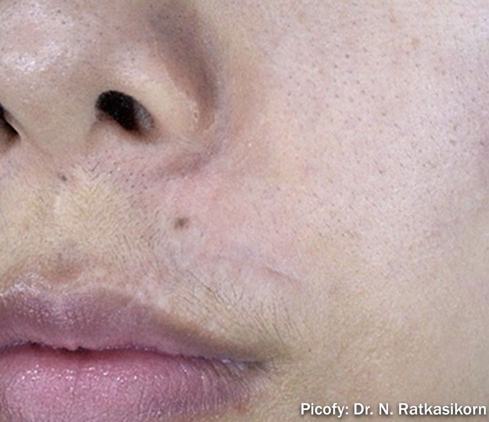 Close-up of a nose and upper lip with a small dark spot above the lip.