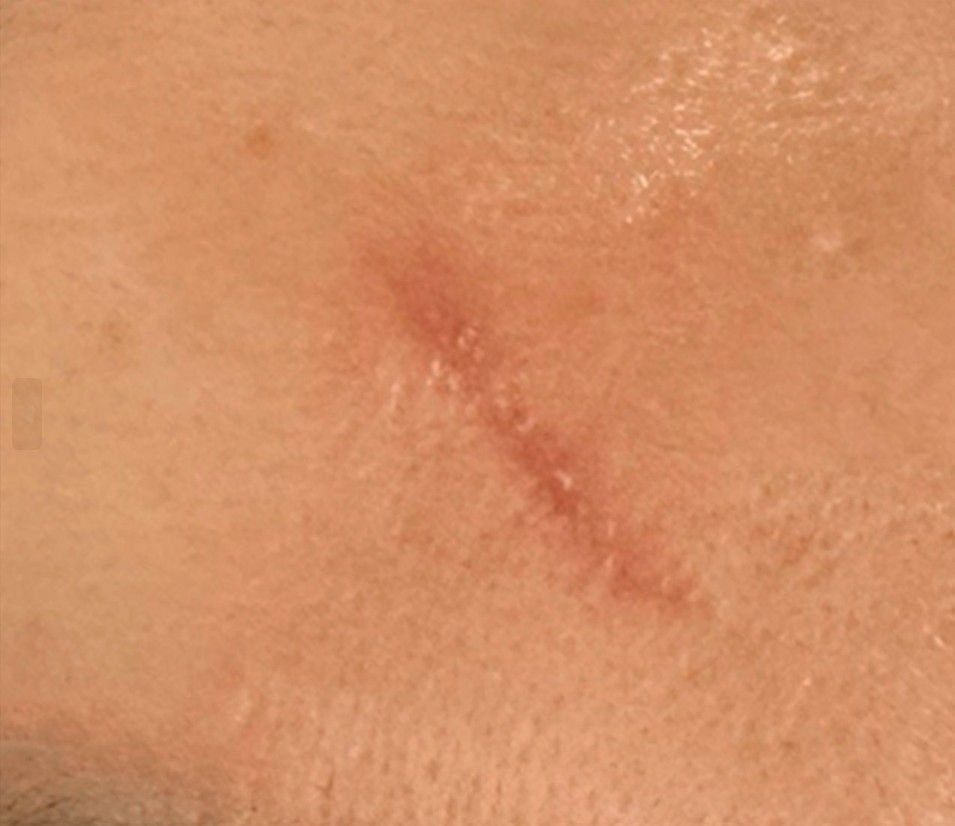 Close-up of a small reddish scar on light skin.