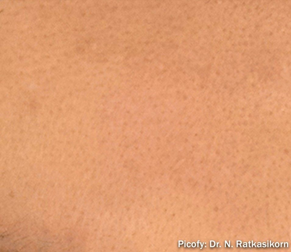 Close-up of light tan, freckled skin texture with a small watermark in the lower right corner