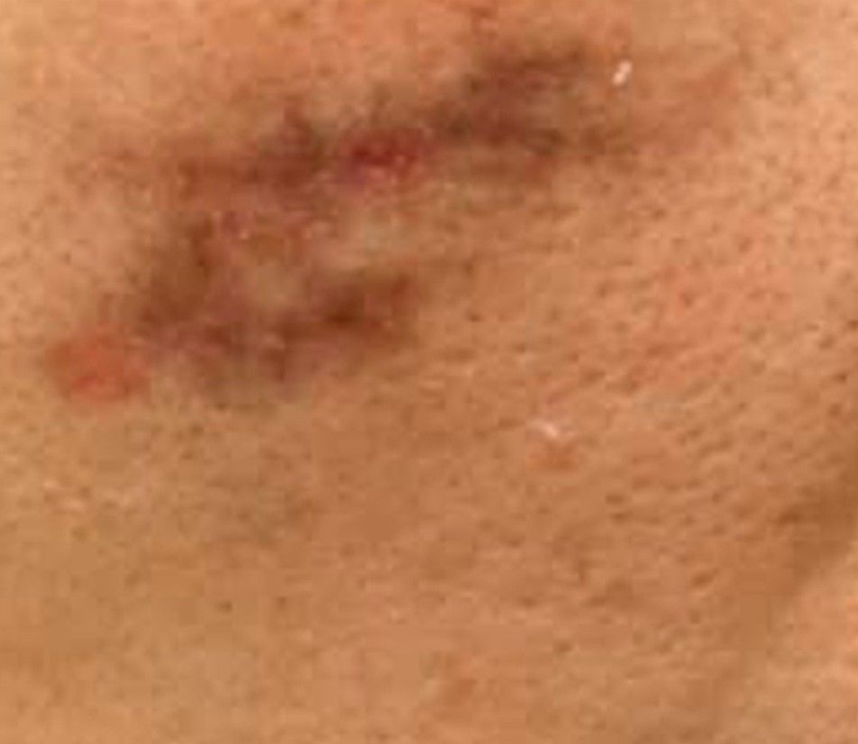 Close-up of a small reddish bruise or skin irritation on beige skin