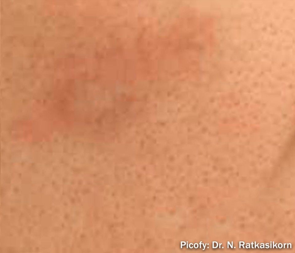 Close-up of light peach skin with a faint reddish bruise or rash.