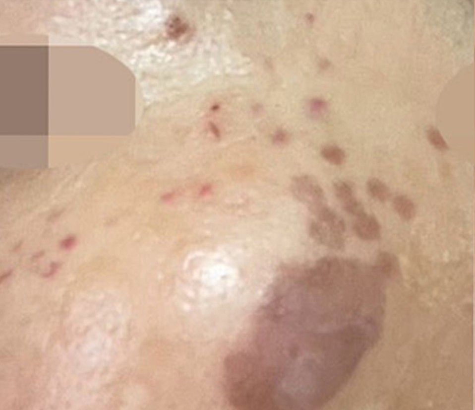 Close-up of skin with multiple red and dark spots and a raised brown lesion