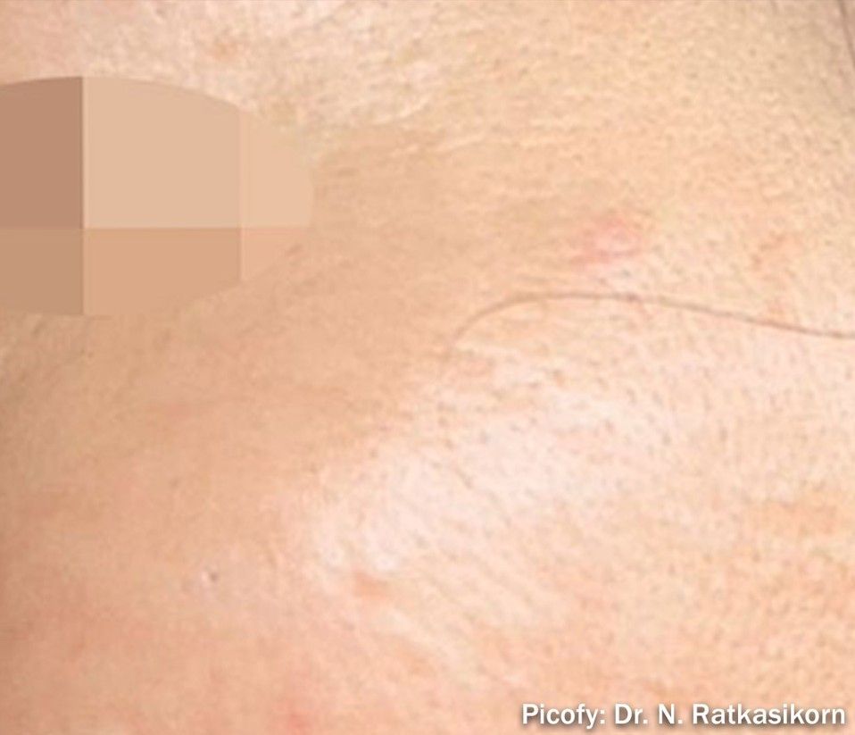 Close-up of a light-colored raised skin bump with surrounding redness