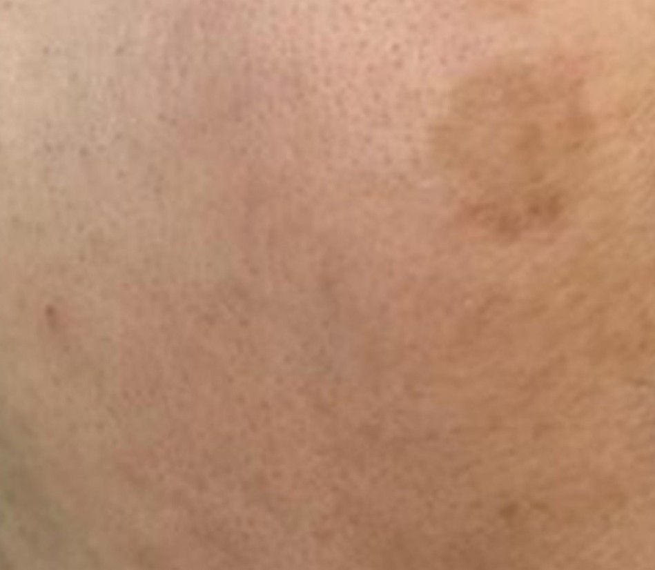 Close-up of light beige skin with a small brown spot or bruise