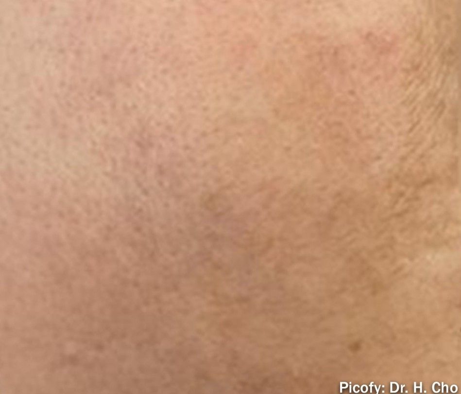 Close-up of skin with a brownish facial discoloration and fine texture