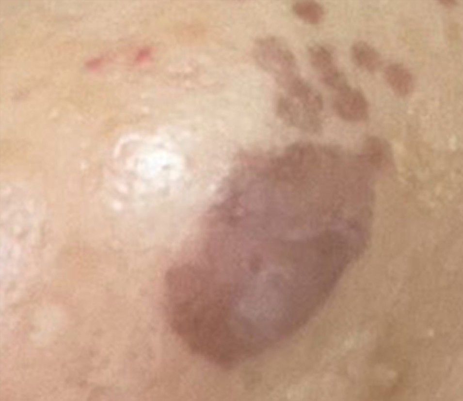 Close-up of a raised dark brown skin lesion with small red spots on surrounding skin