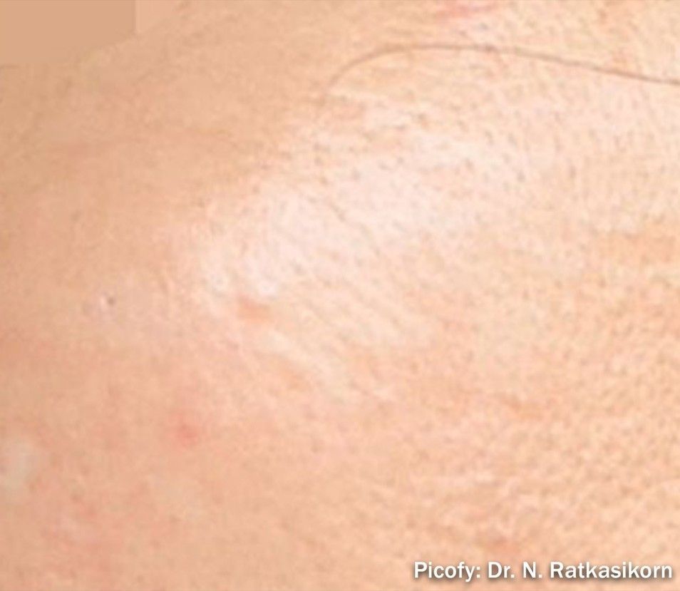 Close-up of a light skin patch with a pale, slightly raised circular bump.