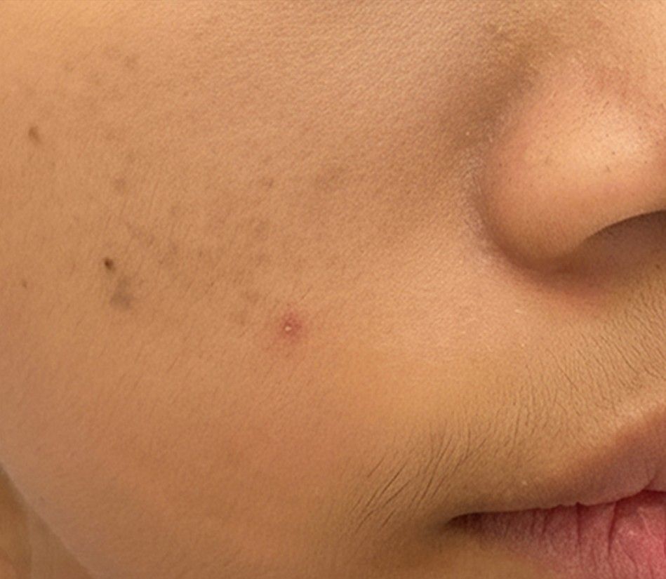 Close-up of a cheek with a small red blemish near the mouth
