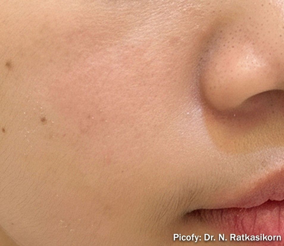 Close-up of a cheek and nose with a few small dark moles on light skin