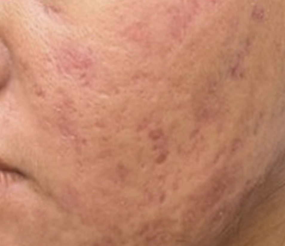 Close-up of a cheek with dark acne scars and skin discoloration