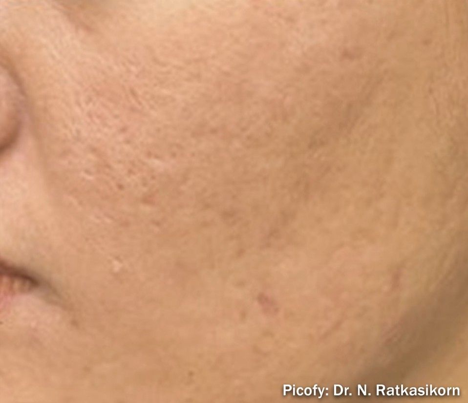 Close-up of a cheek with acne scars and uneven skin texture