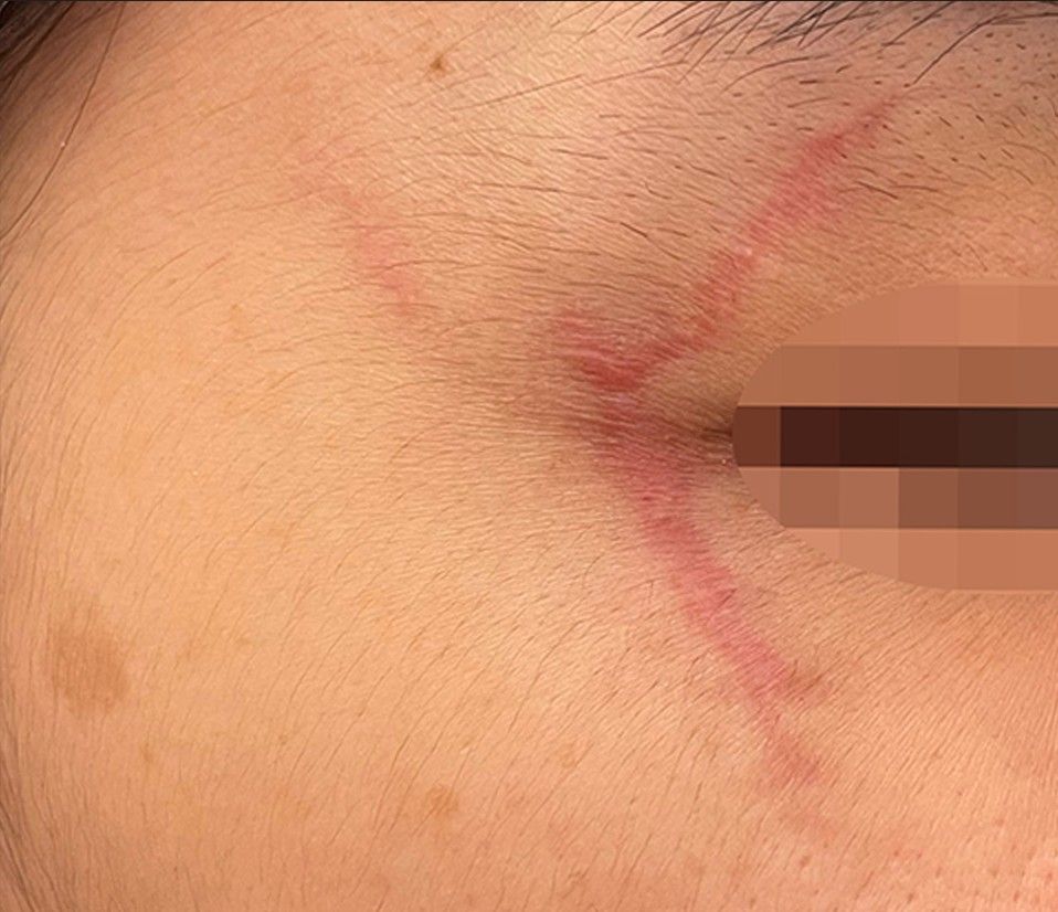 Close-up of skin near an eye with a red, irritated scar line on the cheek