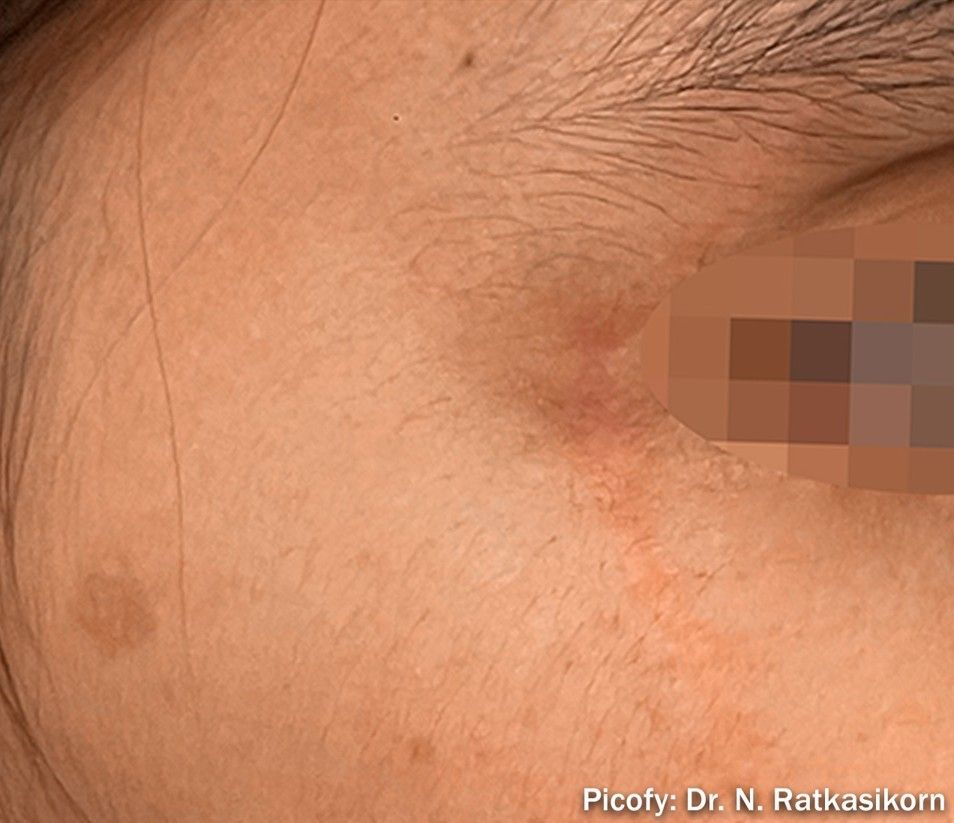 Close-up of a cheek near the eye with a small brown spot and pixelated eye area