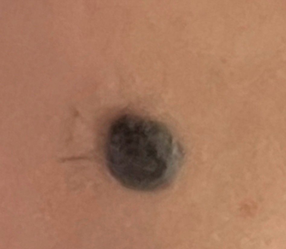 Close-up of a small dark mole on tan skin