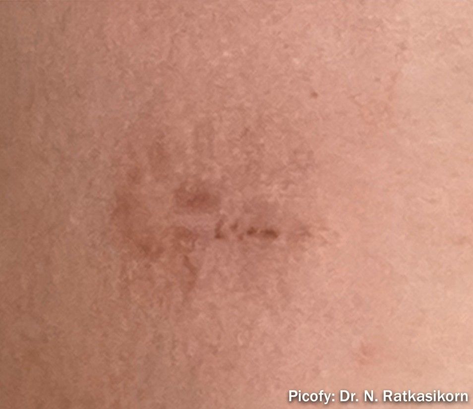 Close-up of a small brown skin scar or healed mark with a faint central line.