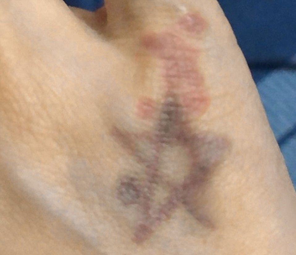 Close-up of a bruised hand or wrist with dark purple and yellow discoloration