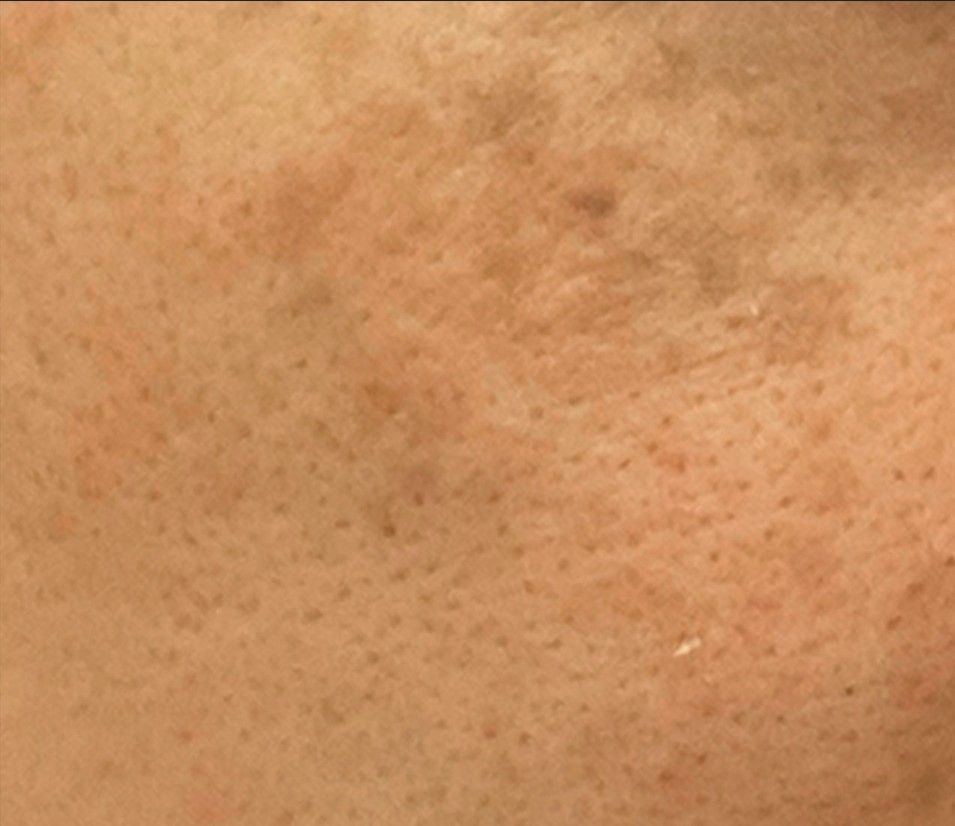 Close-up of a light brown skin patch with scattered dark spots and faint discoloration
