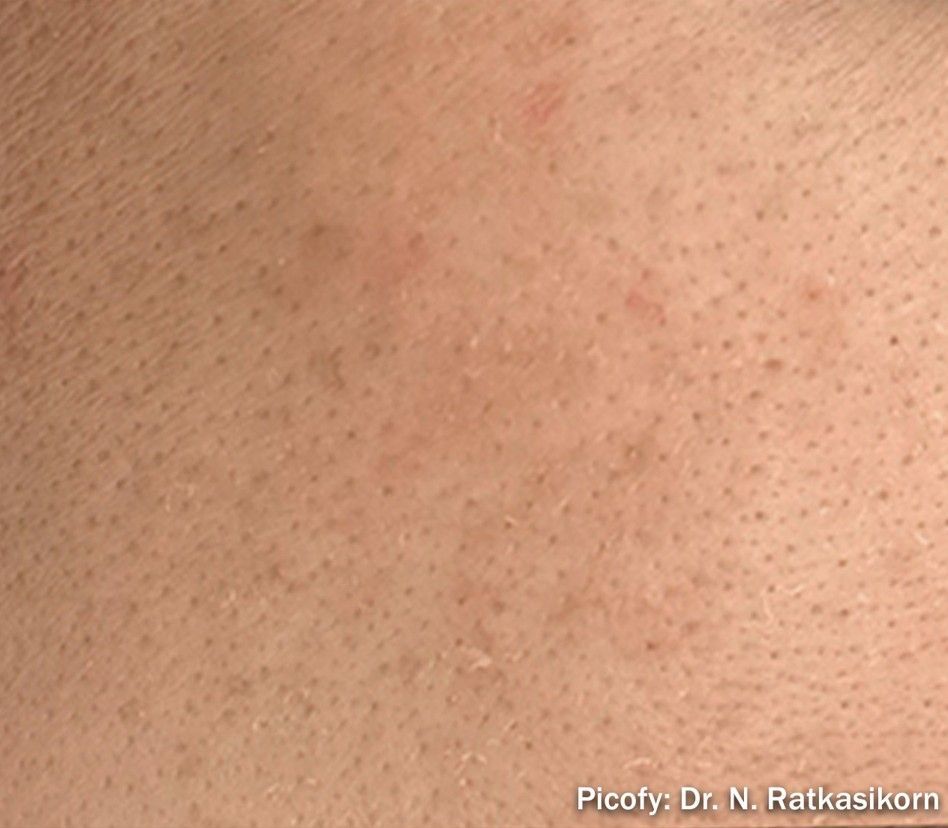 Close-up of human skin with small scattered red bumps and visible pores.