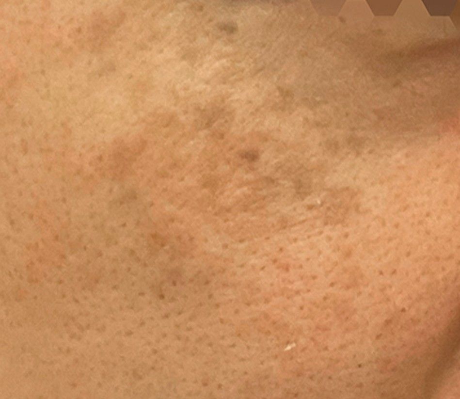 Close-up of skin with dark spots and a textured patch