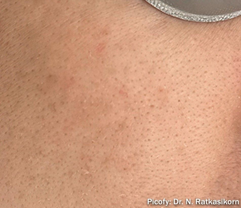 Close-up of skin with numerous small brown freckles and a gray metal edge at the top right.