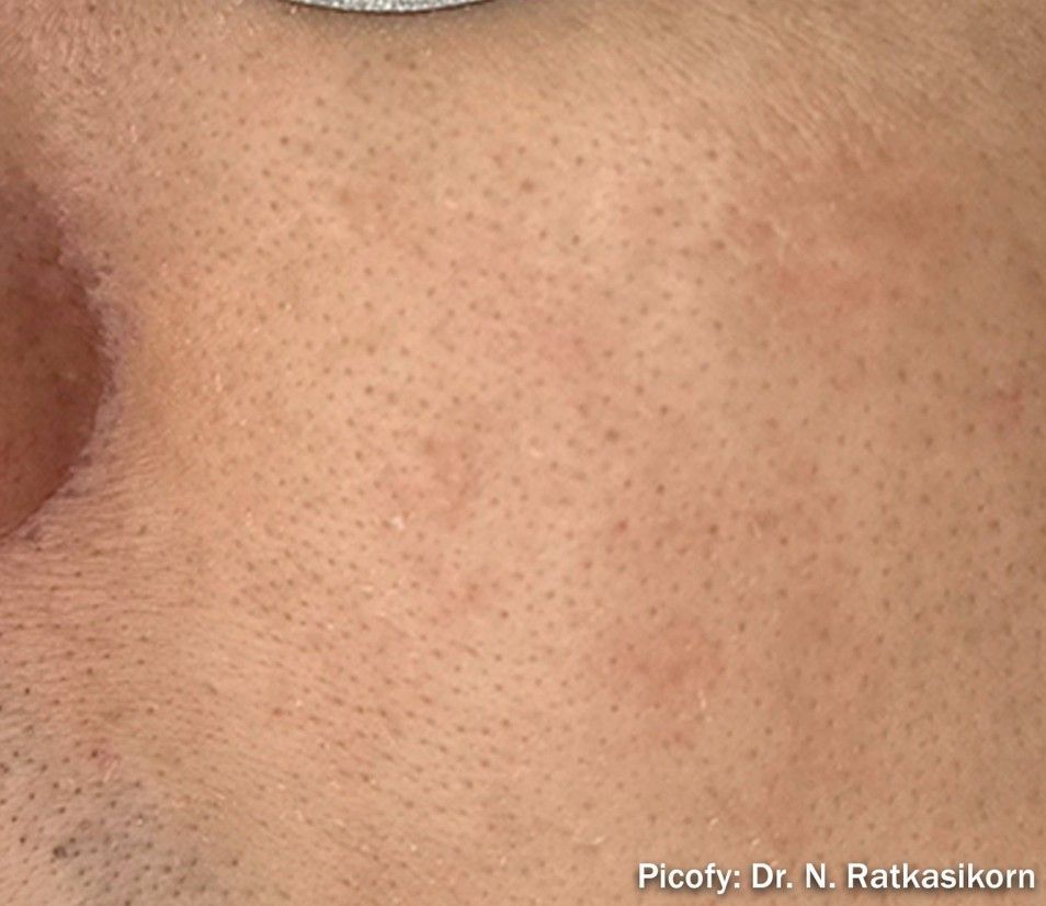 Close-up of pale skin with multiple small red bumps and visible pores