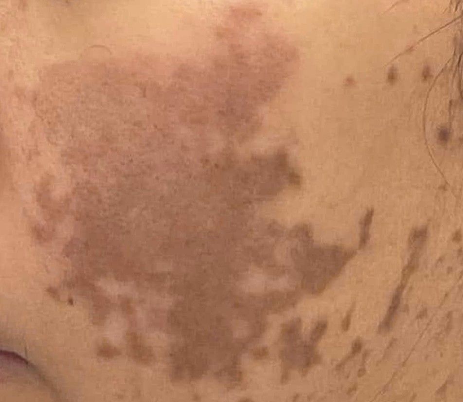 Close-up of a large brown mottled skin patch with smaller dark spots around it