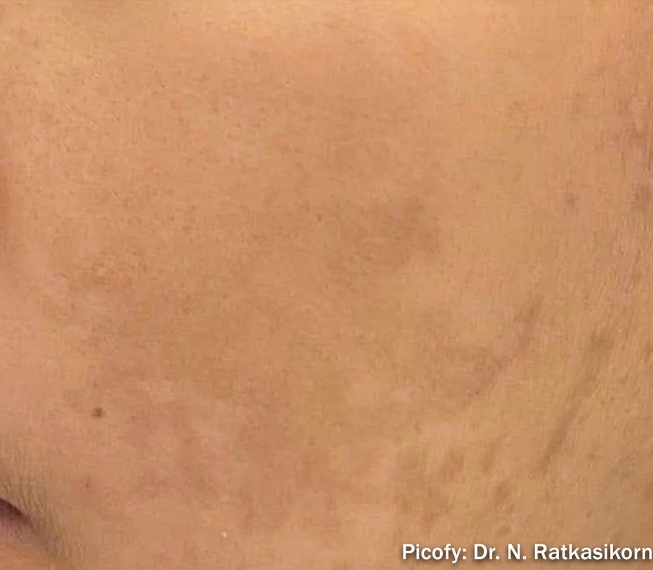 Close-up of a light brown skin patch with faint, irregular darker marks and a small watermark in the corner