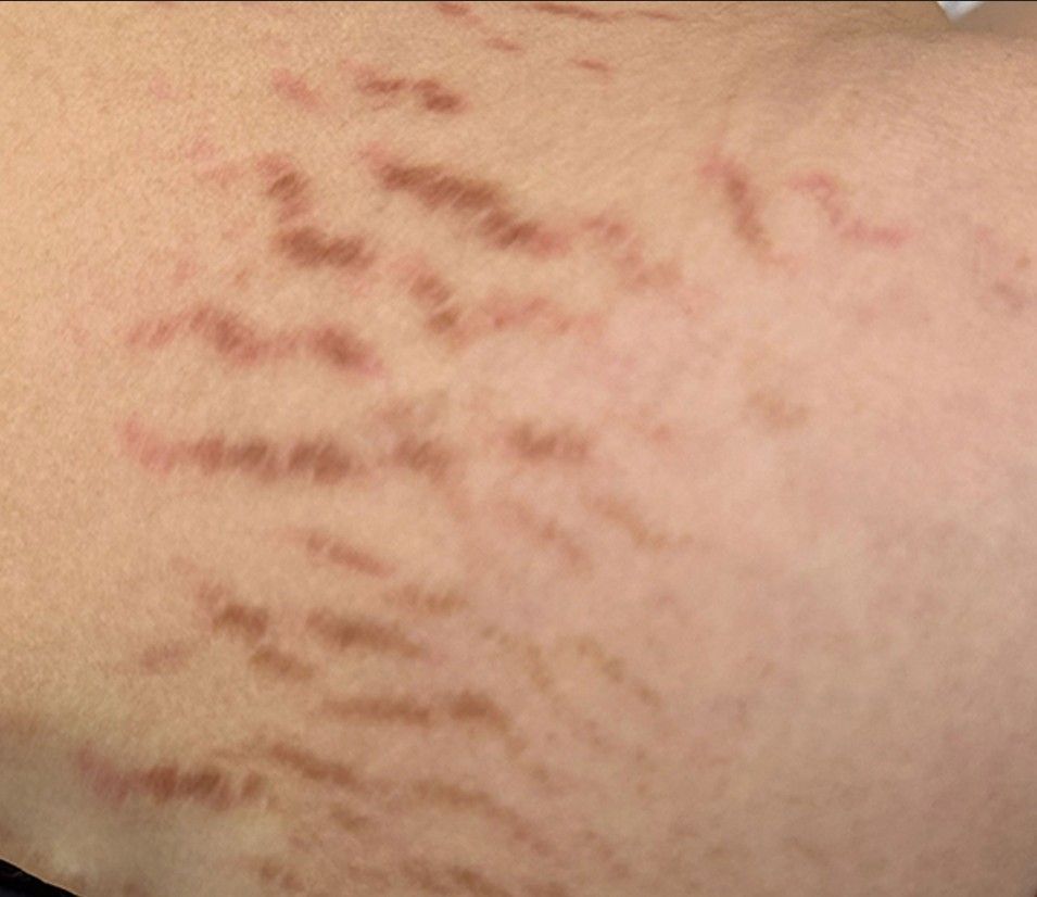 Close-up of reddish scratch marks on skin