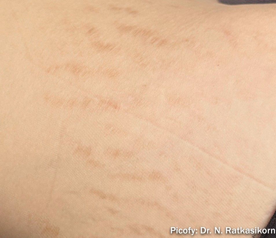 Close-up of pale skin with faint horizontal stretch marks and subtle redness
