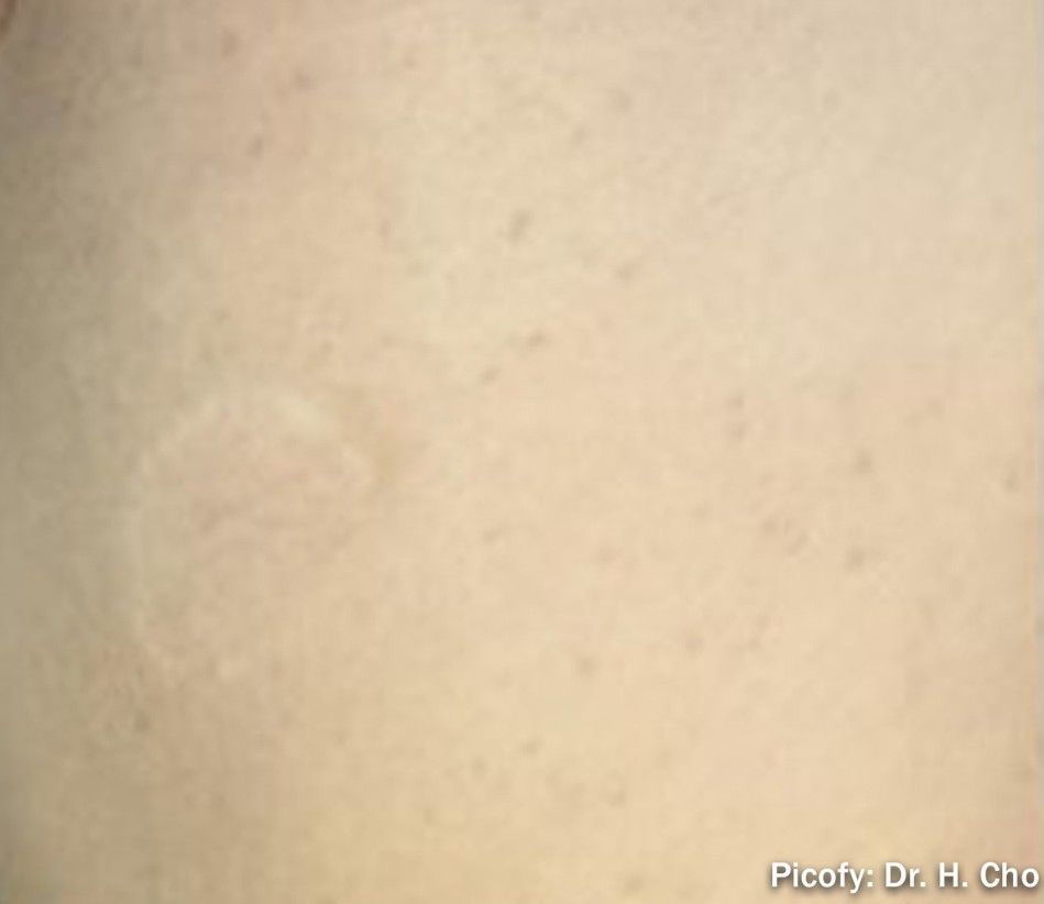 Close-up of light beige skin with a faint circular pale patch