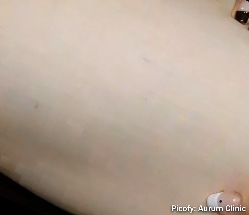 Close-up of pale skin with a small dark mole near the edge, under warm lighting.
