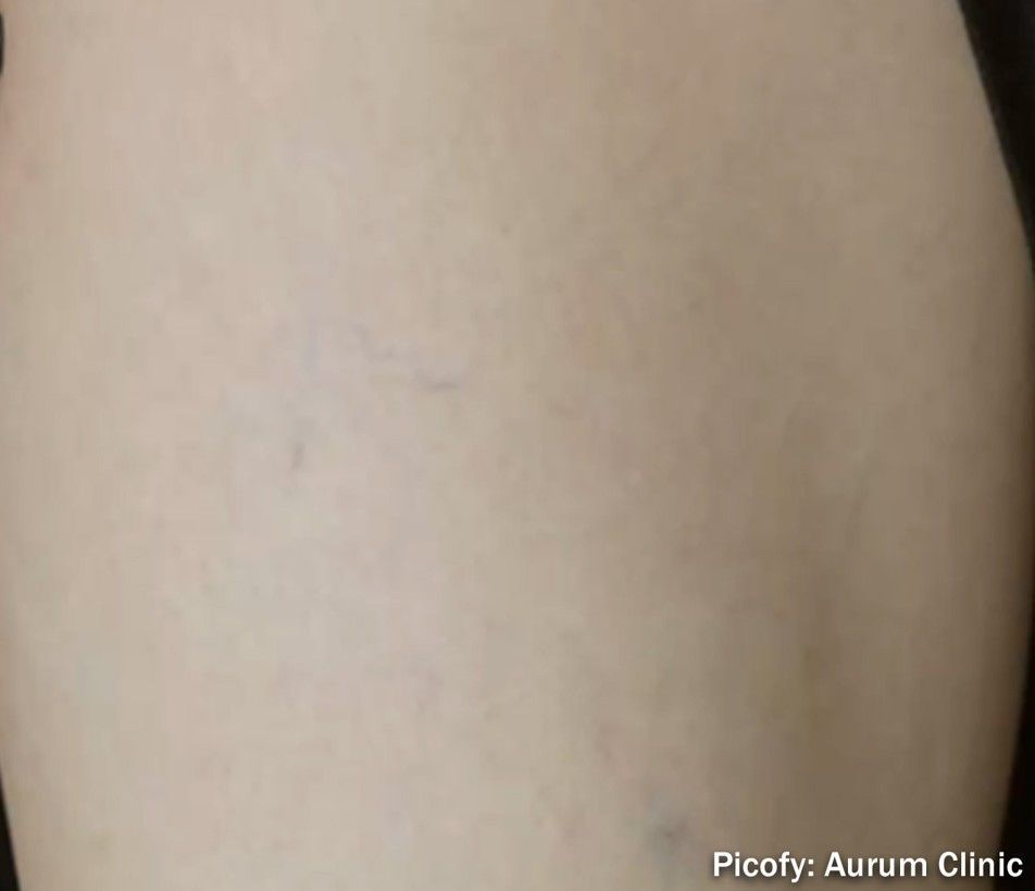 Close-up of a pale arm with faint blue veins against a neutral background