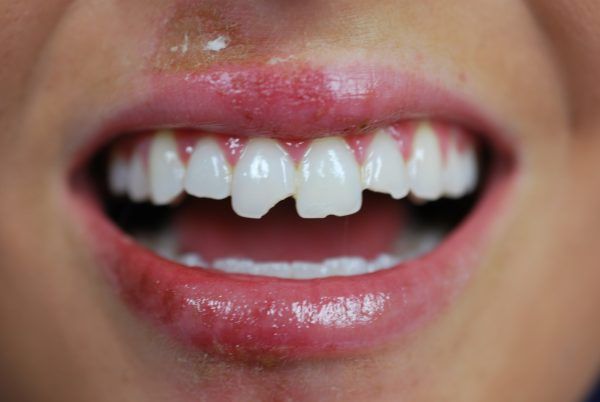 Cracked teeth before