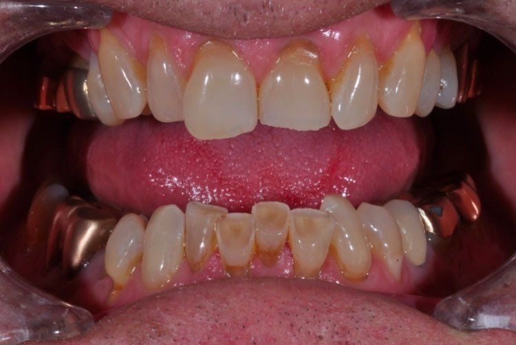 Chipped teeth before