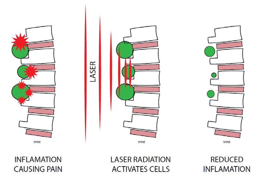 A diagram showing how laser radiation activates cells and reduces inflammation.