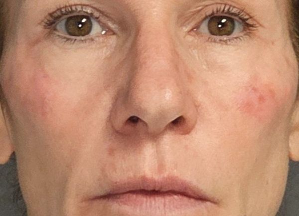 A person's face shows localized, reddish, inflamed skin patches on both cheeks.