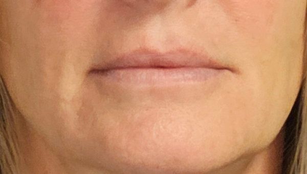 Close-up of a person's mouth and chin area showing mild nasolabial folds and skin texture.