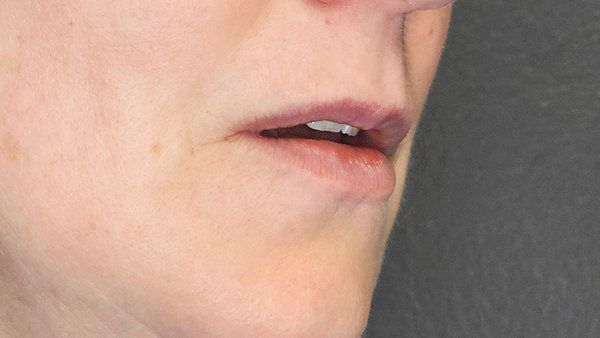 A close-up view of the lower half of a person's face, showing the mouth, chin, and cheek area in neutral lighting.