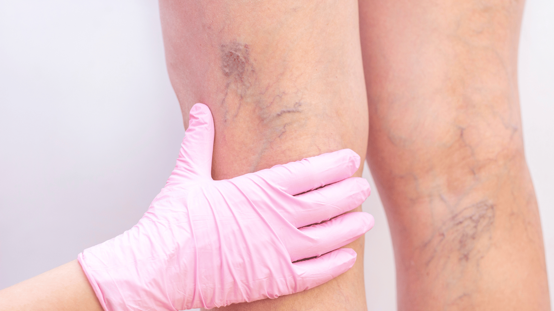 A person wearing pink gloves is examining a woman 's leg with varicose veins.