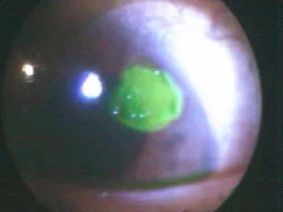 Corneal Abrasion Severe