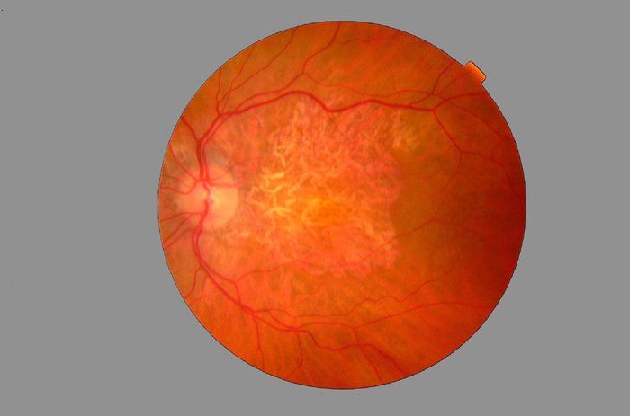Macular Degeneration