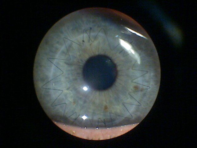 Corneal Transplant