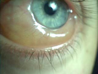 Chemosis